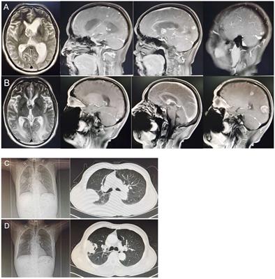 Frontiers Hepatoid Adenocarcinoma Of The Lung With PD L1 Expression